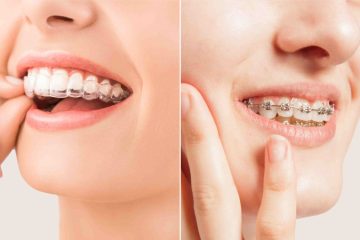 Metal Braces Vs Invisible Braces: Which Is Right For You?